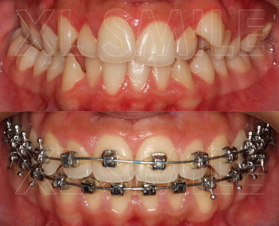 Ortodontia - Correcção de mordida cruzada e apinhamento intenso com aparelho fixo dentário (brackets)