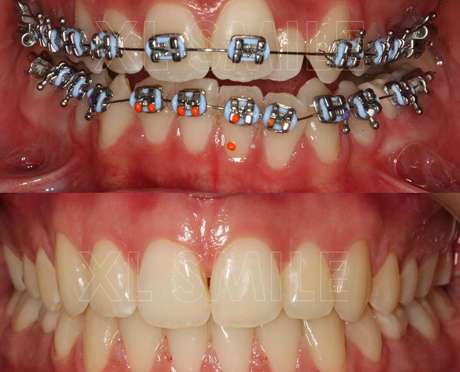 Aparelho Fixo - Ortodontia - Caso 3