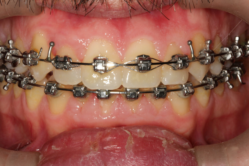 ortodontia - XL Smile