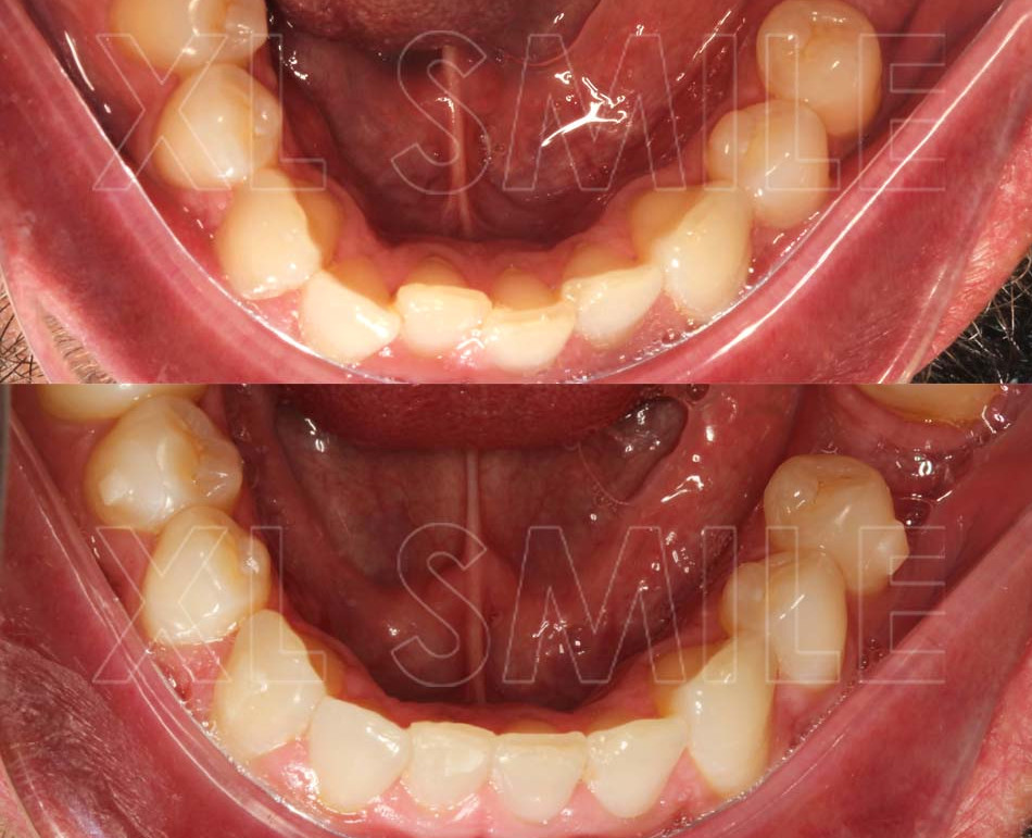 Alinhadores/Aparelhos invisíveis - Correcção de apinhamento dentário sem aparelho fixo (ainda em tratamento)