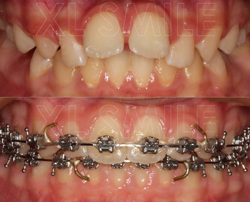 Ortodontia - Correcção de apinhamento intenso com projecção/proangulação dos incisivos superiores - aparelho fixo (ainda em tratamento).