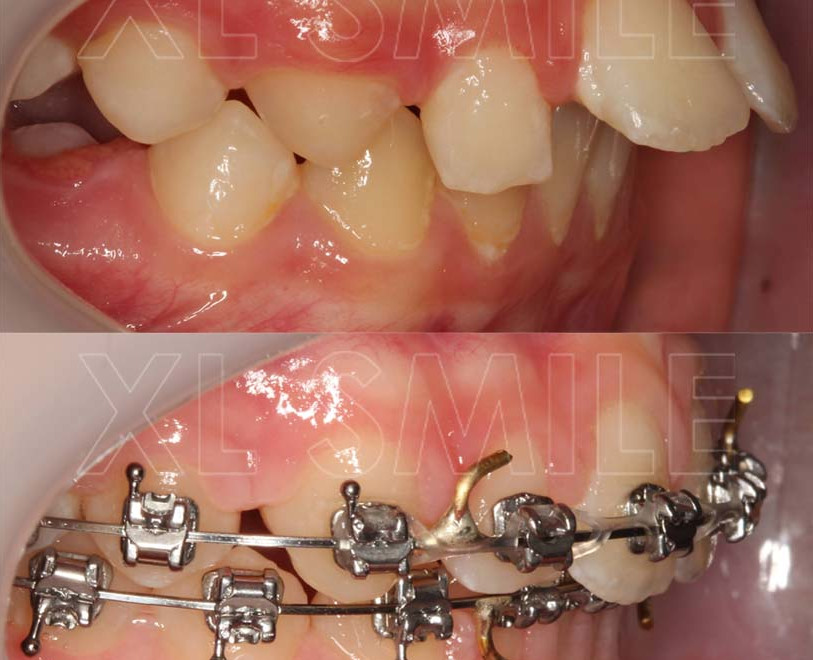 Ortodontia - Correcção de apinhamento intenso com projecção/proangulação dos incisivos superiores - vista lateral (ainda em tratamento).