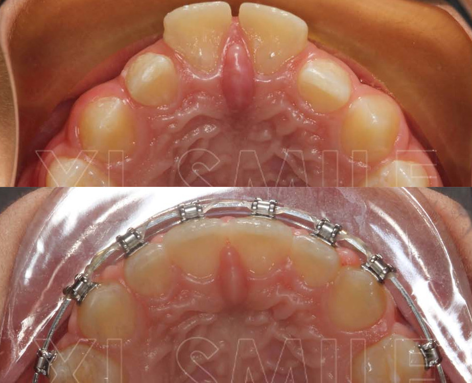 Ortodontia - Correcção de apinhamento intenso com projecção/proangulação dos incisivos superiores - aparelho fixo (ainda em tratamento)