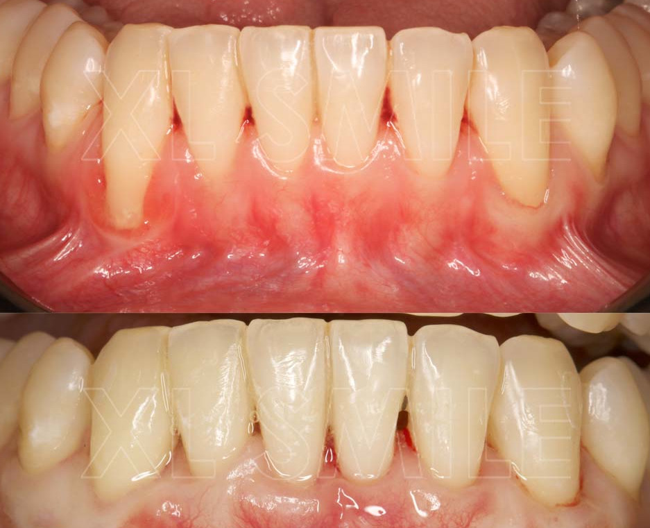 Periodontologia - Micro-cirurgia de enxerto gengival (tecido conjuntivo) para recobrimento de recessão (retracção) gengival e aumento de espessura da gengiva queratinizada do paciente.