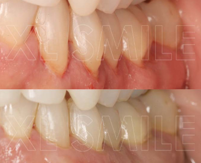 Periodontologia - Micro-cirurgia de enxerto gengival (tecido conjuntivo) para recobrimento de recessão (retracção) gengival e aumento de espessura da gengiva queratinizada do paciente.