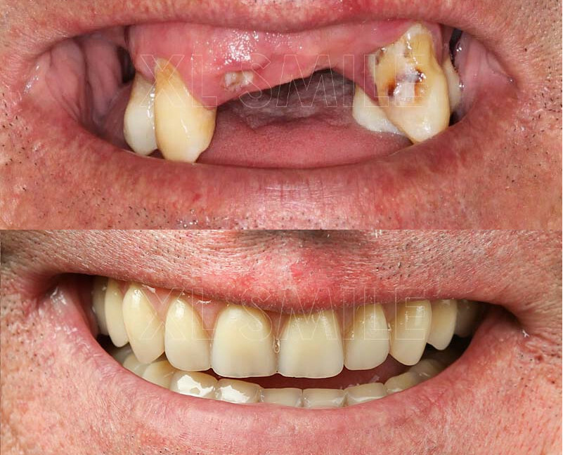 Dentes Fixos num dia - Carga Imediata - Caso 1