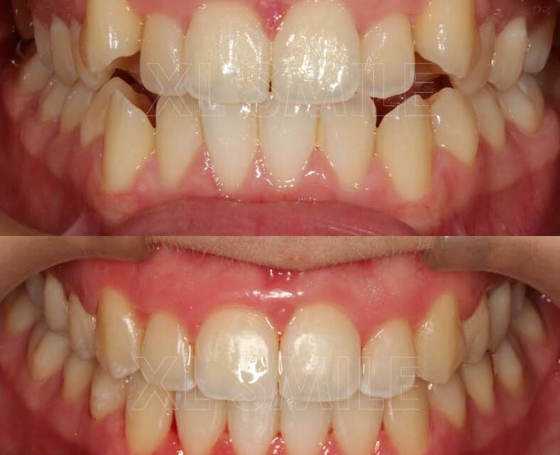 Aparelho Fixo - Ortodontia - Caso 2