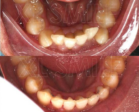 Aparelho Fixo - Ortodontia - Caso 4