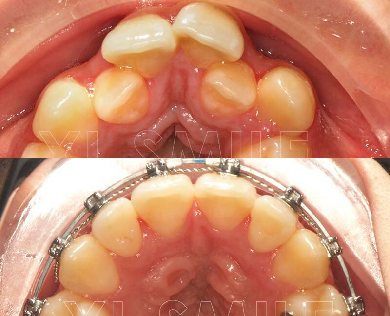 Aparelho Fixo - Ortodontia - Caso 5