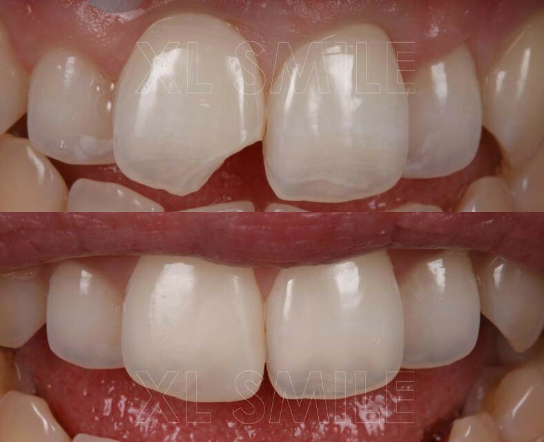 Restauração estética de um dente fracturado