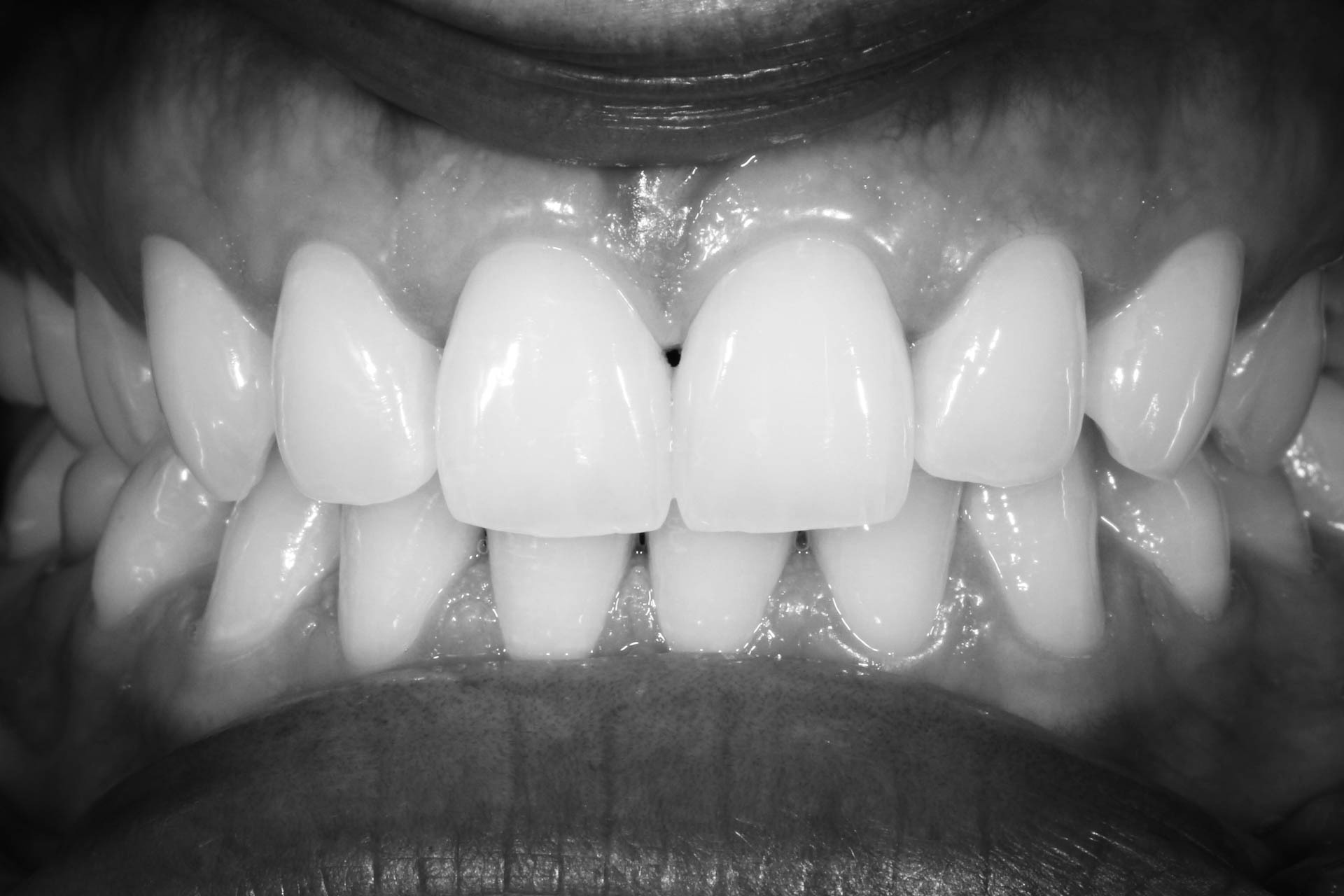 Branqueamento Dentário - XL Smile