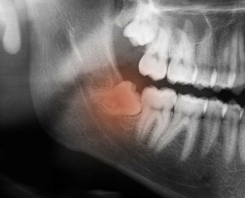 Cirurgia Oral