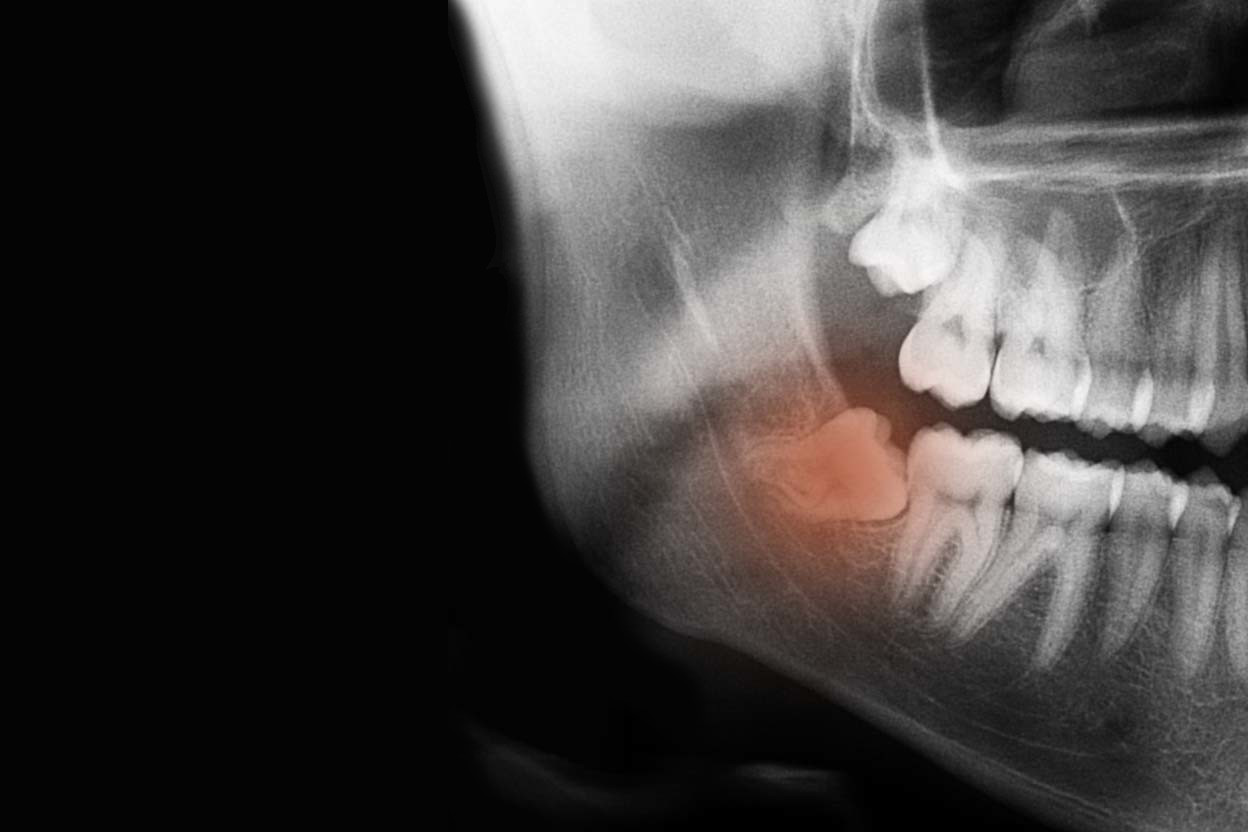 Cirurgia Oral - XL Smile