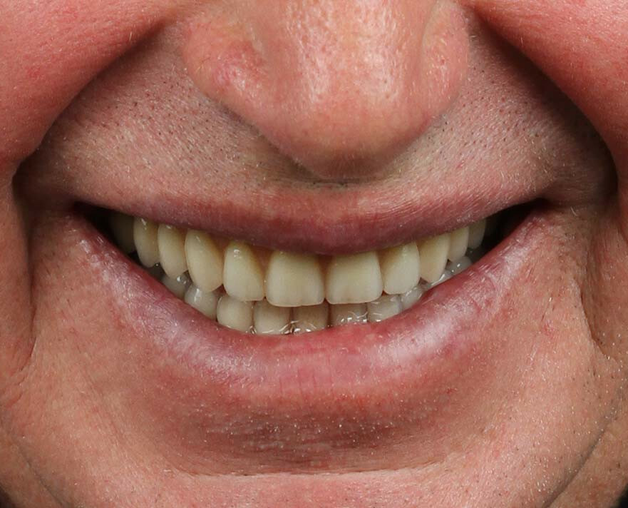 Dentes Fixos num dia