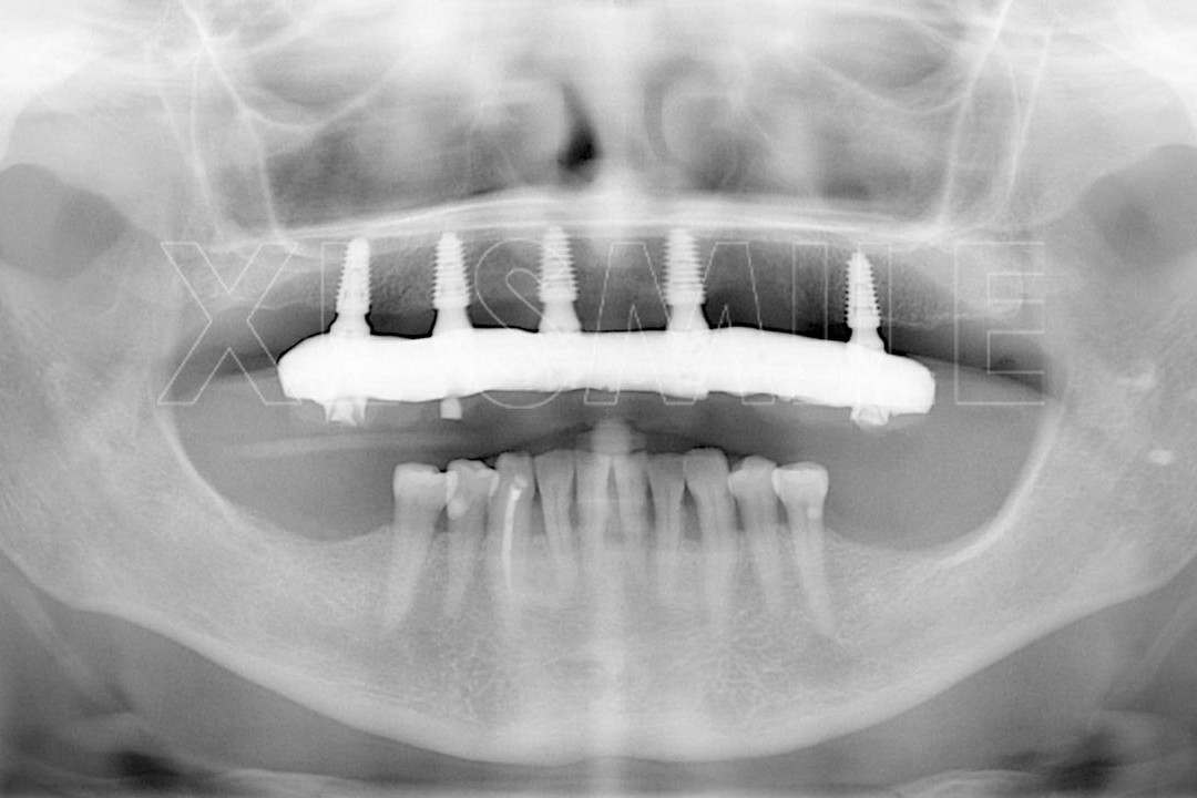 Implantes Dentários - XL Smile