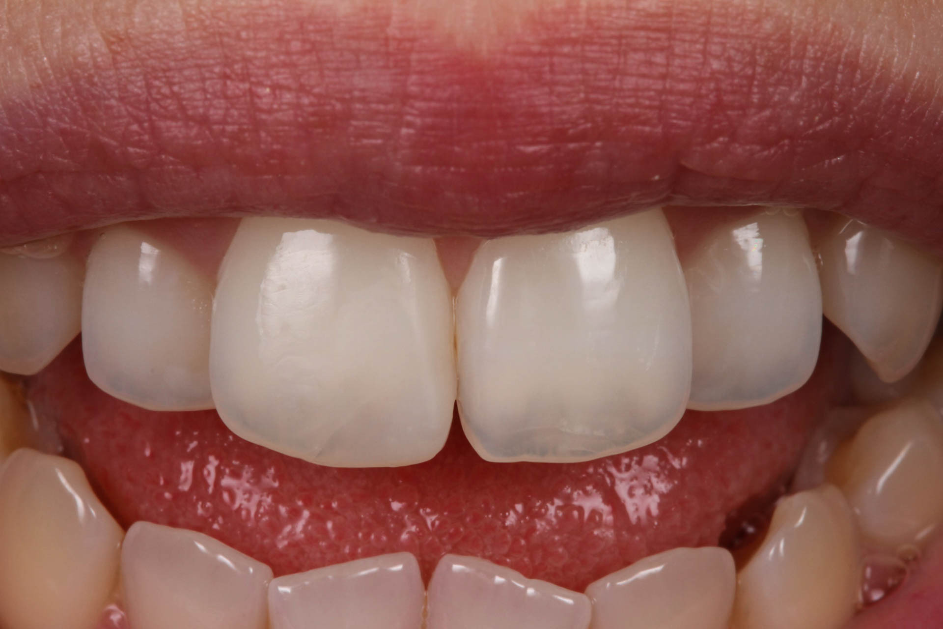  Dentisteria estética - XL Smile