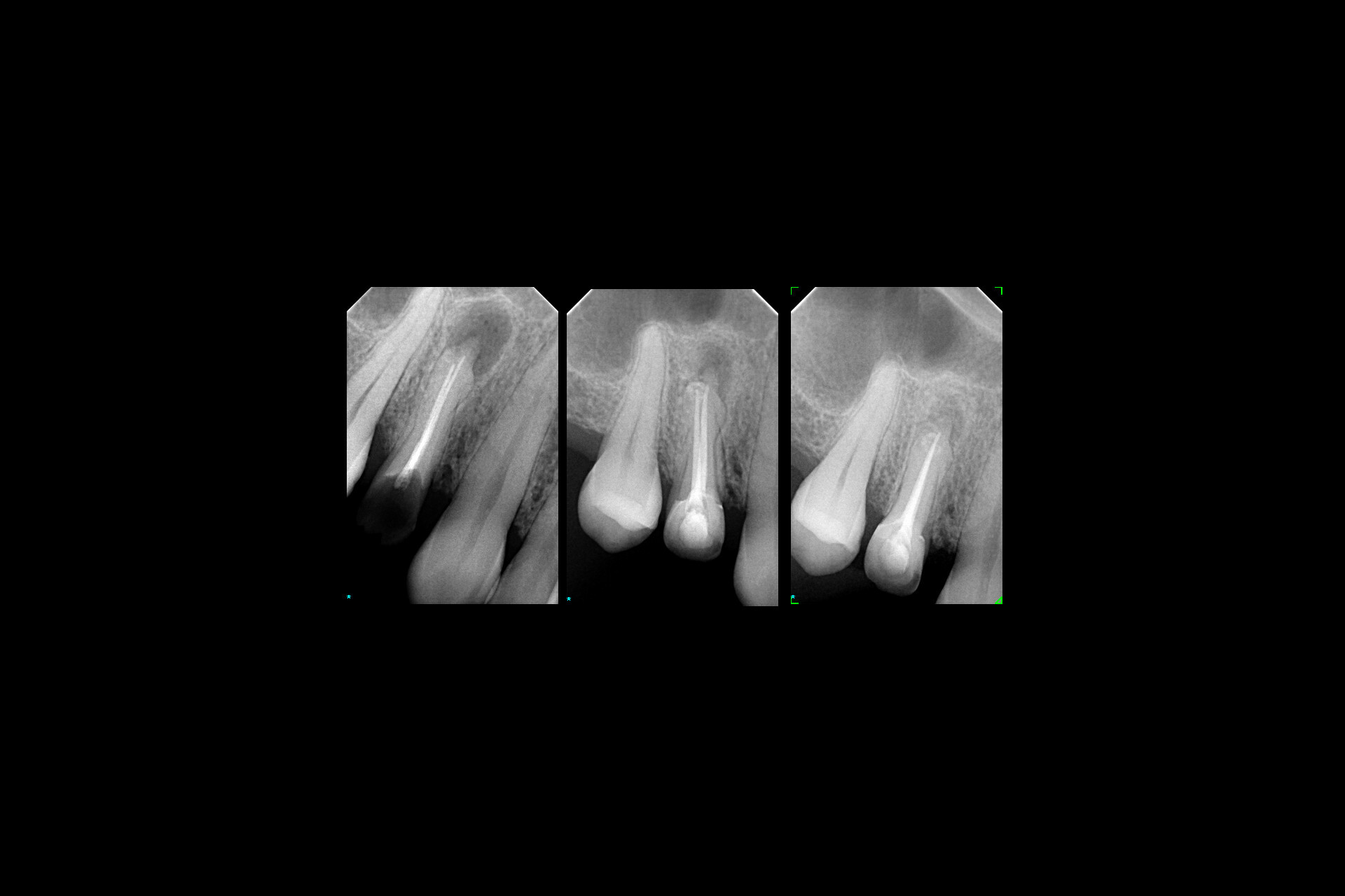 Endodontia - XL Smile