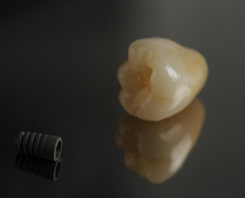 Implantes Dentários