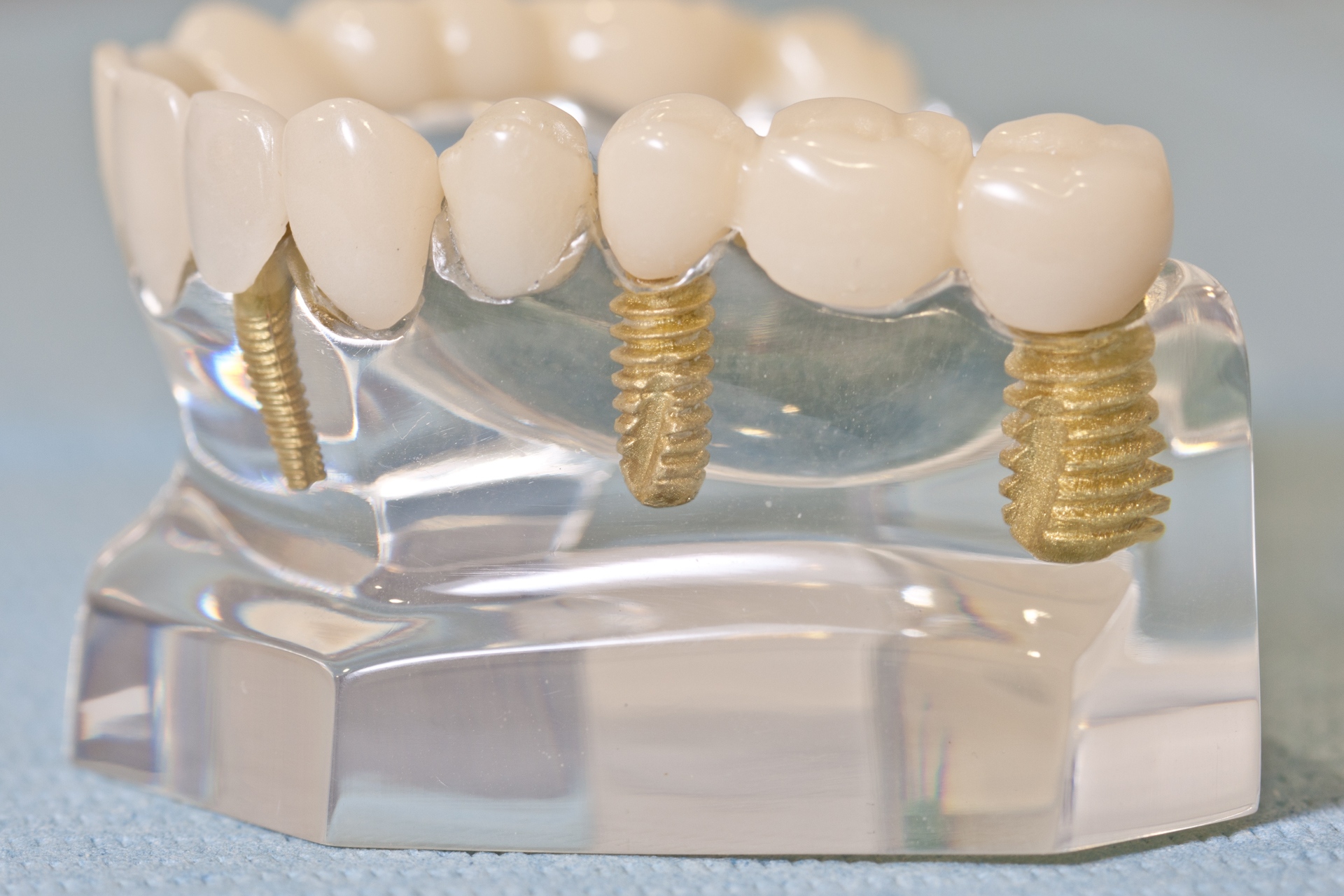 Implantes Dentários - XL Smile