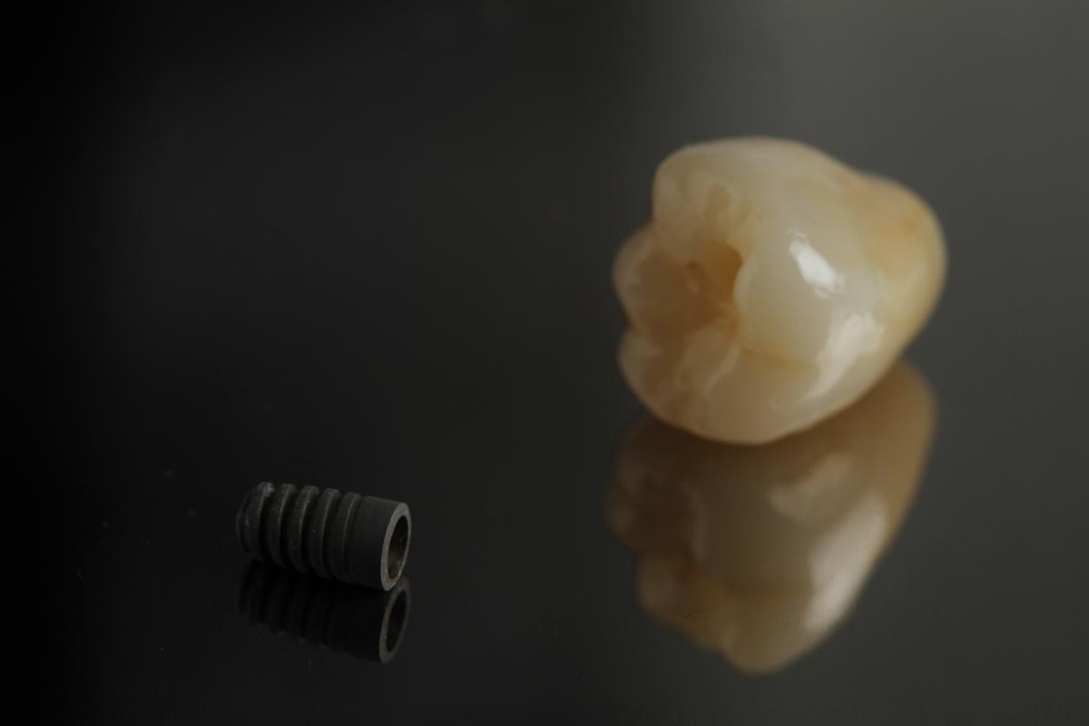 Implantes Dentários - XL Smile