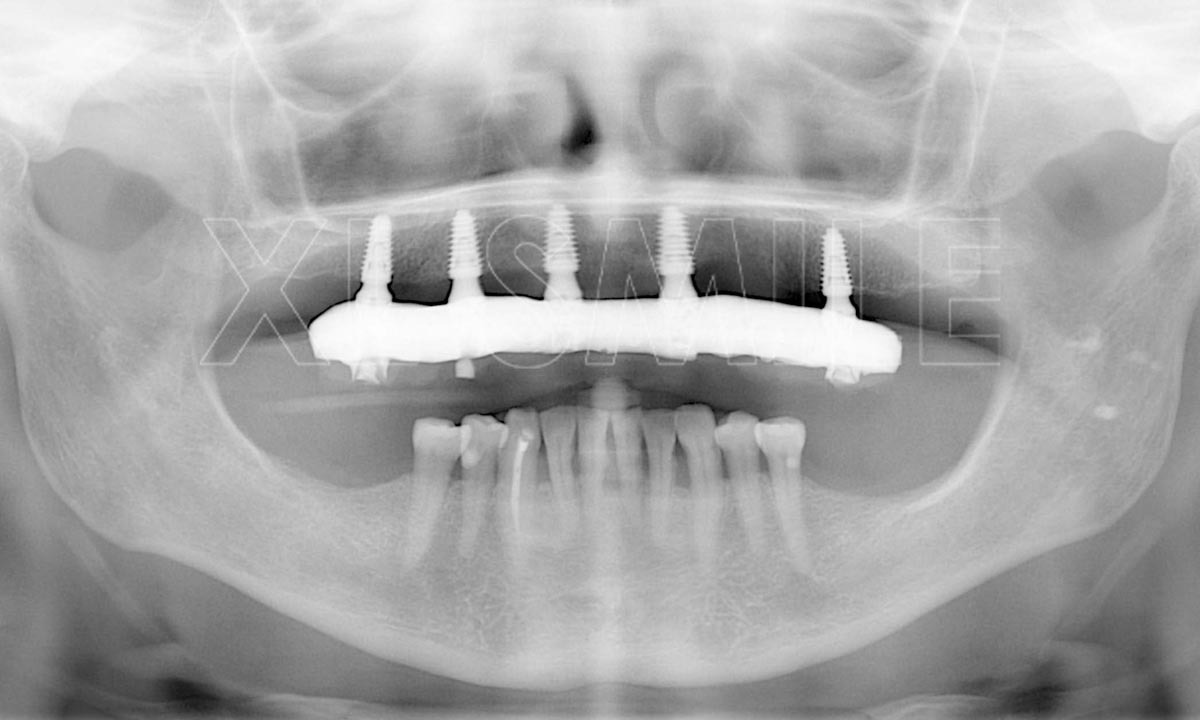 Implantes Dentários - XL Smile