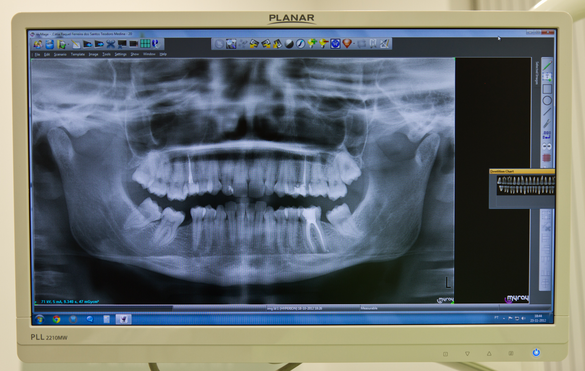 Oclusão, Dor Orofacial e Disfunção da Articulação Temporo-mandibular - XL Smile