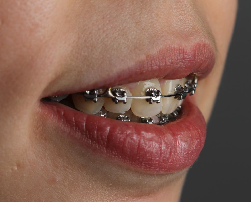 Ortodontia/Aparelhos Fixos Dentários