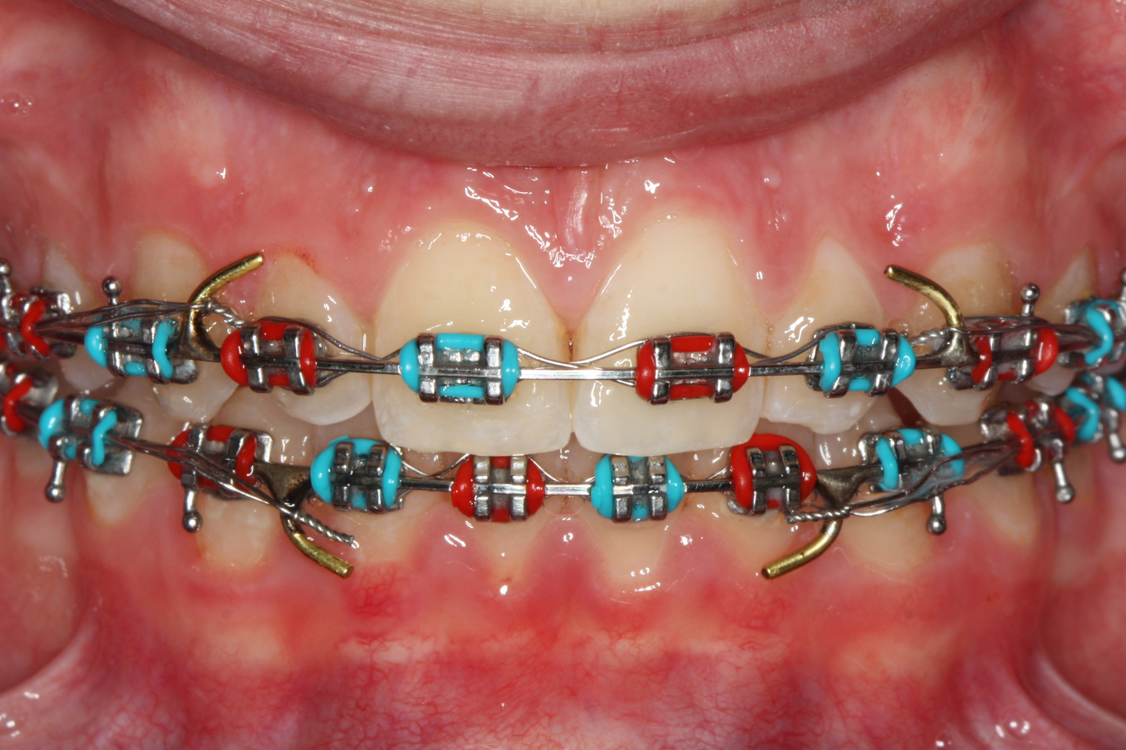 ortodontia - XL Smile